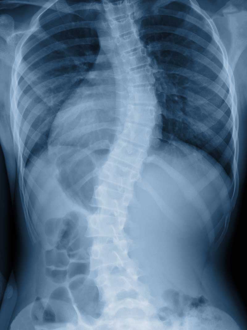 An X-ray image of a human torso, clearly showing severe S-shaped scoliosis of the spine and the surrounding rib cage.